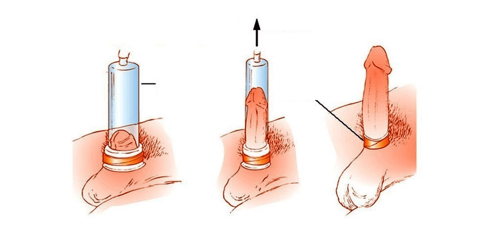 πώς λειτουργεί μια αντλία κενού για τη διεύρυνση του πέους
